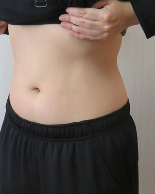 痩せた後の腹部の写真